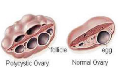 Dietary management for PCOS