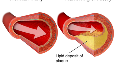 A healthy heart diet