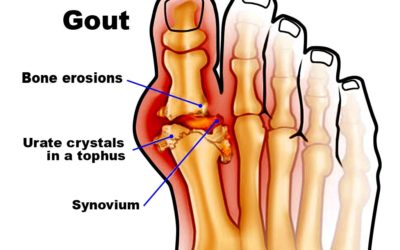 Dietary advice for gout